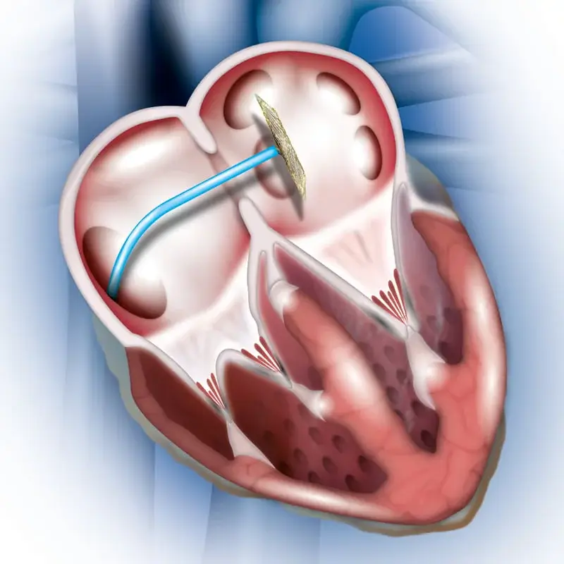 Transcatheter closure