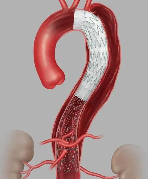 Stenting for Coarctation of Aorta