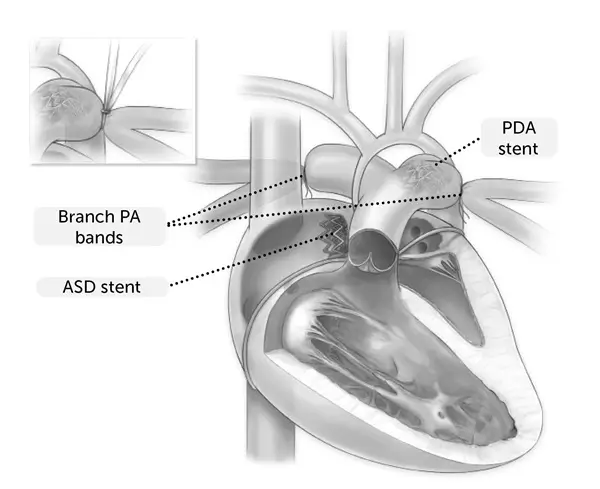 PDA Stenting / Branch Pulmonary Artery Stenting